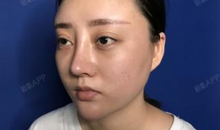 做鼻子要多少钱 做鼻子要多少钱